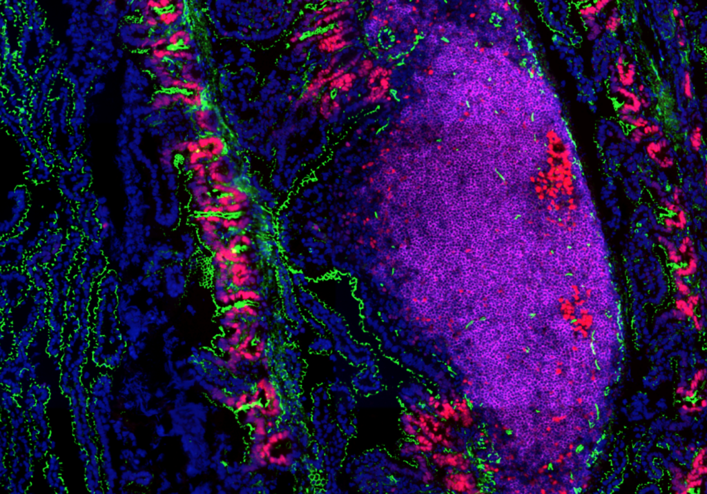 Revolutionising the treatment of bowel inflammation in a childhood auto ...